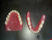 Removable Partial Denture
