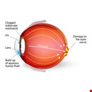 Glaucoma Test in London
